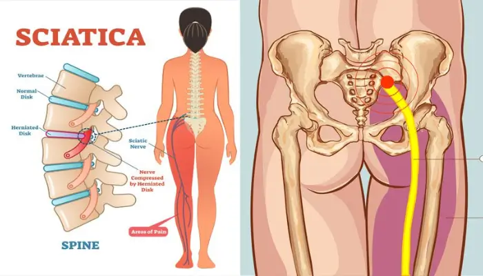 What is Sciatica and sciatica pain? / best chairs for relieving pain sciatica